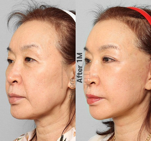 韩国面部提拉手术是怎样的?分享韩国迪美整形面部提升特色!