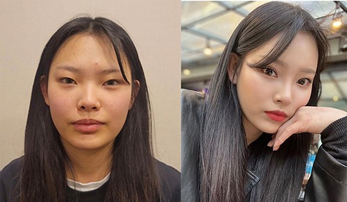韩国迪美眼鼻额头填充案例分享 土相感姑娘简单三项变好看!