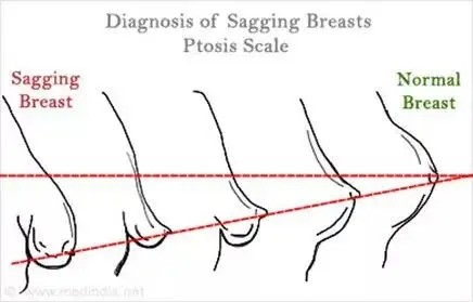 福州胸部下垂矫正哪家医院好?分享三家乳房下垂矫正好医院