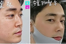 韩国迪美驼峰鼻矫正示例分享,想拥有好看的鼻型并不难