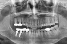 牙医不建议亲属种牙是真的吗 千万不能陷入种植牙这些误区