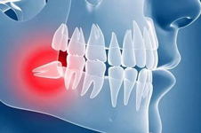 智齒一定要拔掉嗎？不疼也需要拔掉嗎？了解智齒不拔危害