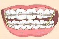 為什么矯正要拔四號(hào)牙或者五號(hào)牙？拔牙矯正結(jié)果會(huì)怎么樣