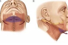 什么是颈阔肌成形术？颈阔肌成形术效果好吗能维持多久？