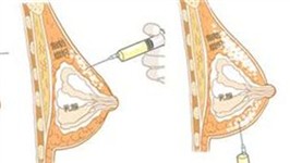 产后胸部下垂干瘪如何恢复弹性丰满？自体填充效果好吗？