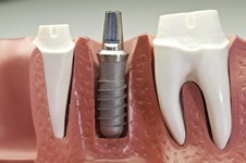 牙医没说的种植牙危害有哪些？这几点你一定不知道