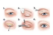 腫眼泡內(nèi)雙怎么變雙眼皮?腫眼泡加內(nèi)雙適合割雙眼皮嗎?