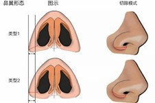 鼻翼缩小手术大概需要多少钱？公布2021国内鼻翼缩小价格表