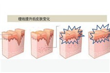 埋线提升面部可以维持多久？术后会有副作用吗？