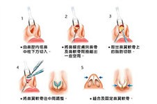 苏州做个鼻综合要多少钱?苏州这些医院做鼻部整形口碑好!