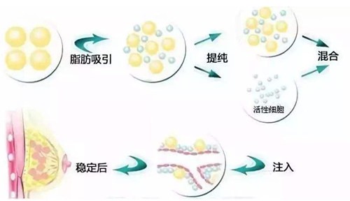 自体脂肪丰胸三天小了好多？真的是手术失败了吗？