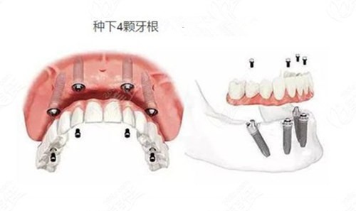 天津美莱口腔收费高吗？从价格表揭秘院内种植正畸费用！