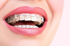正畸牙齿后遗症太可怕了？所以有些牙医不建议正畸吗？