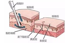 背部抽脂是幾個(gè)部位圖片？背部抽脂是不是整個(gè)背部？