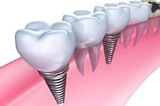 已有新技术替代种牙？无种植仿生牙是代替种牙新技术？