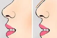 隆鼻手术常见的五大问题有哪些？