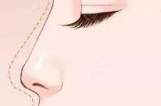 隆鼻和综合隆鼻有什么不同？