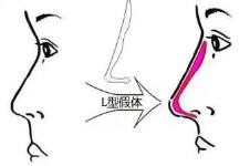 关于隆鼻，哪种假体造成的鼻部后遗症更小？