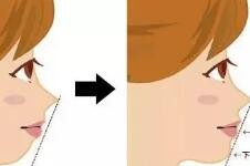 隆鼻假体取出后鼻子会更低吗？