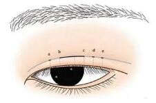 双眼皮手术50%磨眼球，放任不管恐伤眼！