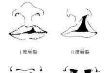 兔唇是怎么形成的？韩国修复兔唇多少钱？