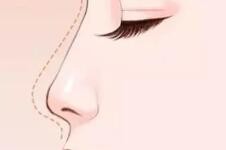 隆鼻手术适合哪种鼻型的人做？驼峰鼻能做吗？