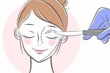 韩国v-line瘦脸手术全过程