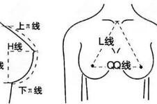 韓式無痕隆胸的優(yōu)勢有哪些