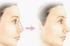 线雕隆鼻露线原因有哪些？该怎么处理？