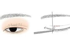 生物焊接双眼皮手术原理分析，效果明显吗？