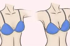 美护护理日记：假体隆胸术后注意事项