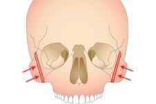 科普3D颧骨旋转术，从此不再担心手术效果！