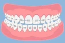 戴牙套能改善凸嘴吗？不做手术可以吗？