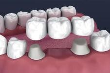 固定假牙如何安装？聊聊关于固定假牙的选择和使用