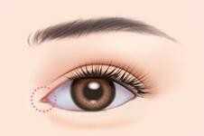 韩国WOOA妩阿整形外科眼整形项目介绍，具体优势有这些！