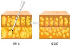 腹部抽脂手术费用、危害及过程详解，切胃减肥大可不必