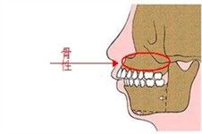 骨性龅牙和牙性龅牙对比照太揪心！是手术还是矫正？