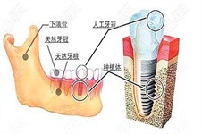 牙齿缺失但是缝隙不够种牙怎么办？可以直接关闭缝隙