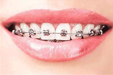 海南靠谱的牙齿正畸医生有哪些?教你分辨好的正畸医生!