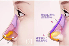 海南哪家医院做鼻综合好?这几家技术超好值得推荐!