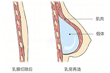 海南乳房再造医院排名，乳房再造修复手术这几家值得推荐!