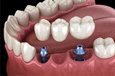 三亚种植牙医院排名更新，三亚种牙口碑好的牙科都在这里