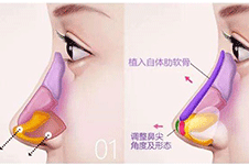 揭秘三亚肋骨隆鼻技术好的医院，三亚肋骨隆鼻来这就对了