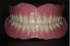 bps全口吸附性义齿价格多少钱?与普通活动义齿有什么区别?