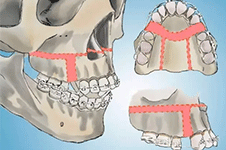 正颌手术有什么后遗症?正颌手术会对人一辈子有影响吗?