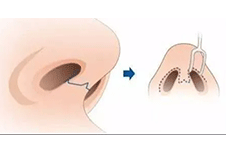 鼻小柱缩短手术效果怎么样？鼻小柱缩短手术好做吗?