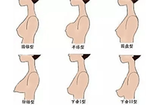 胸型有哪几种分类？按乳房形态大小可分为六大类！	
