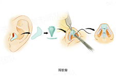 耳软骨垫鼻尖鼻头反而更大了，具体原因及解决方案讲解！