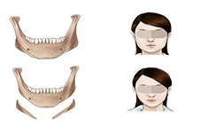 脸部骨骼大  应该用什么方法来瘦脸？