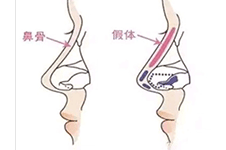 韩国鼻部整形失败类型及修复方法大盘点